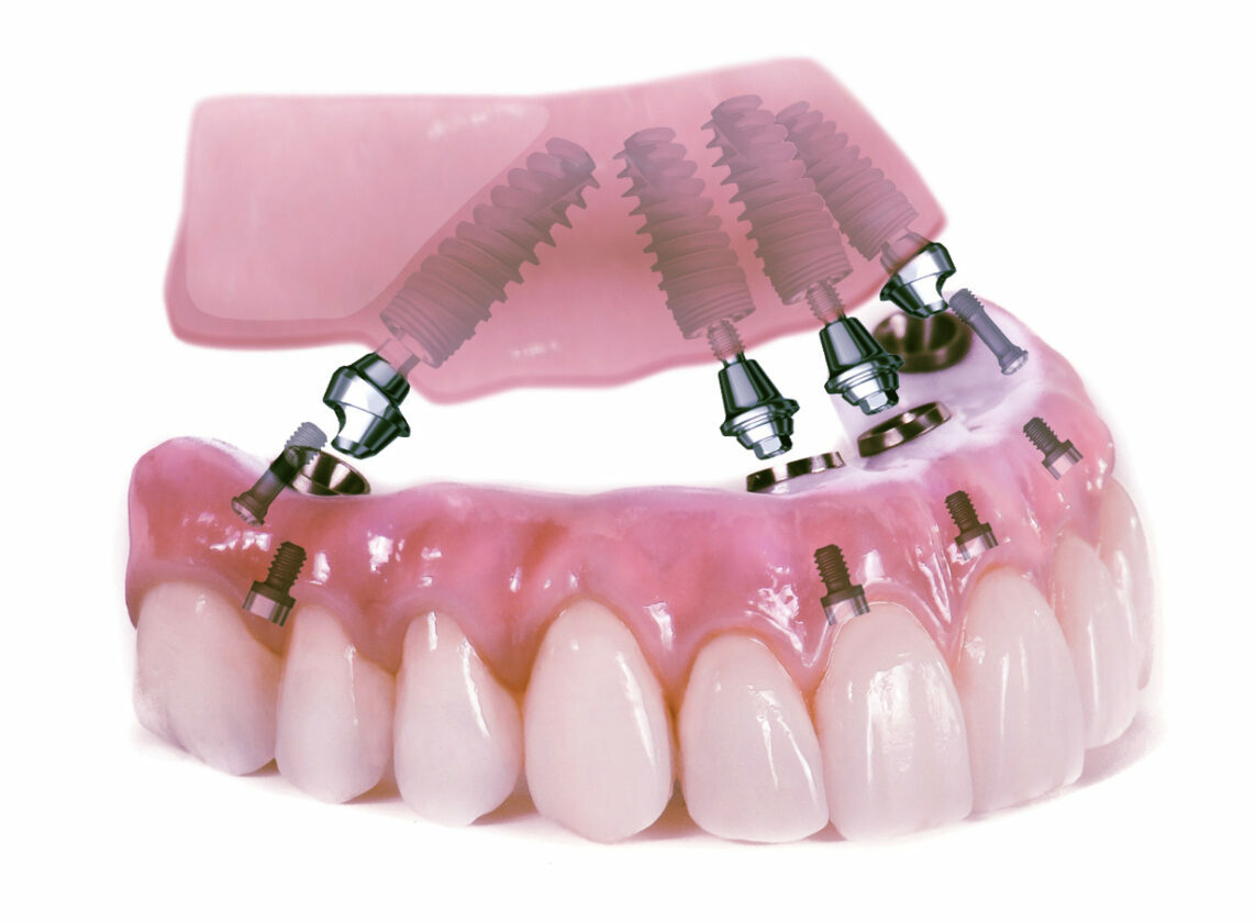 Dental implants Tasmania Innova dental