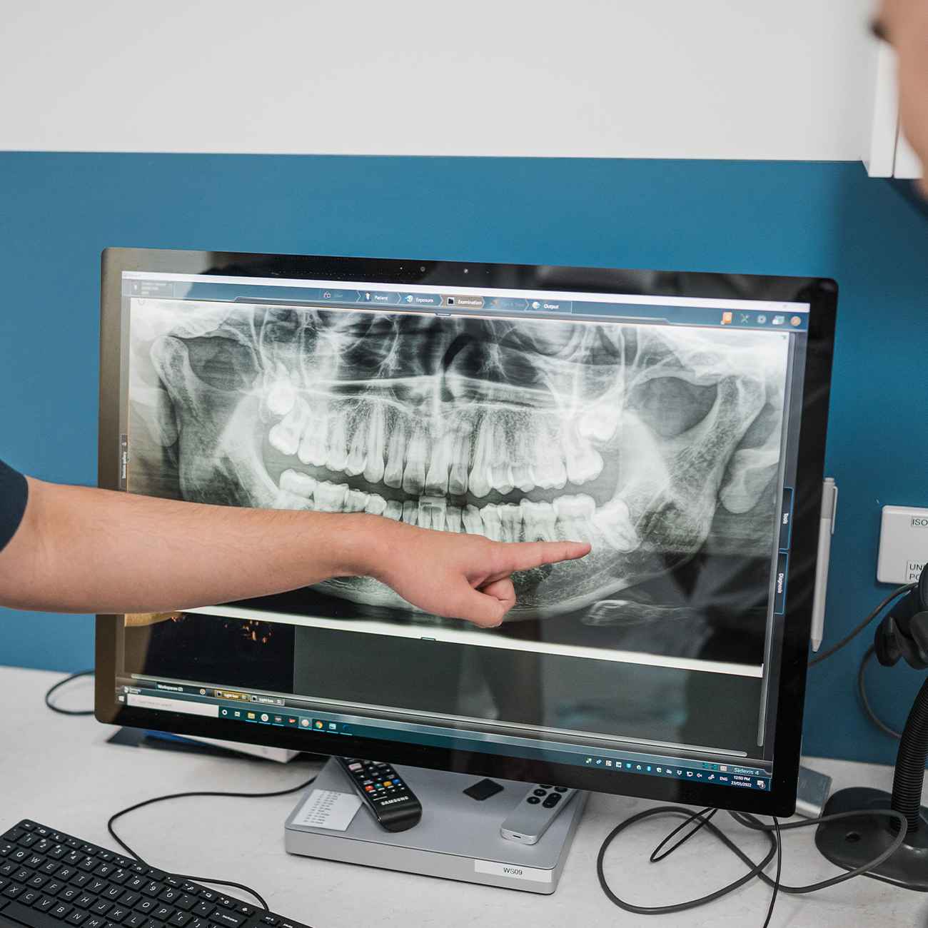 full arch implants